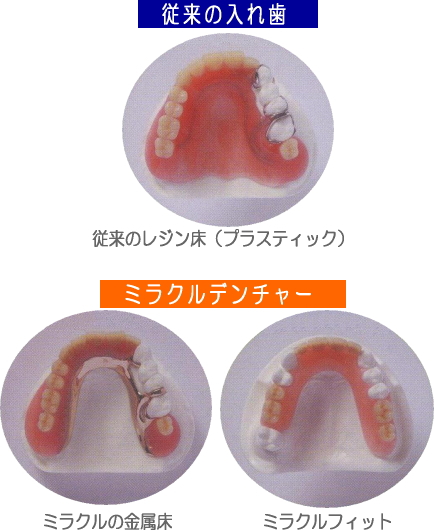 従来の入れ歯とミラクルデンチャー